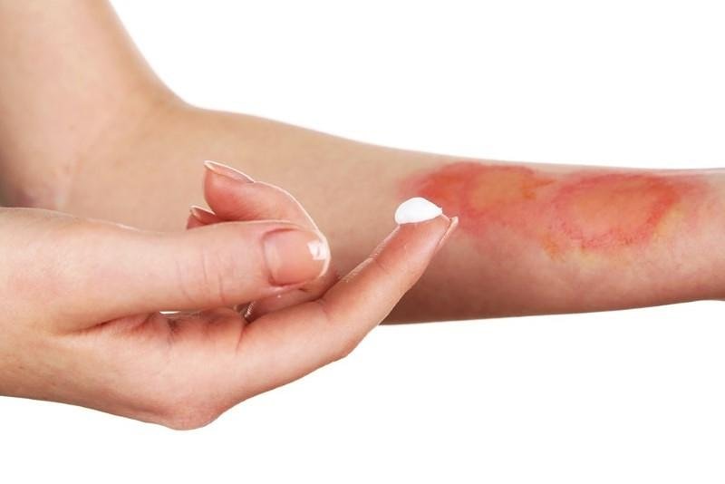 First Aid for Burns: How to Treat and Prevent Burn Injuries