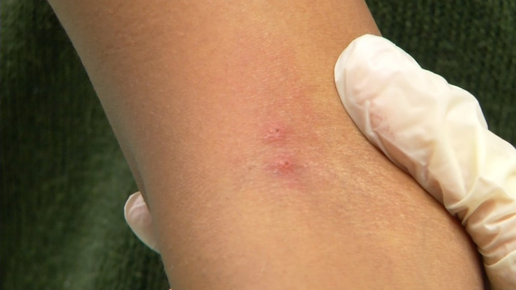 HOW TO PROTECT YOURSELF FROM TICK BITES