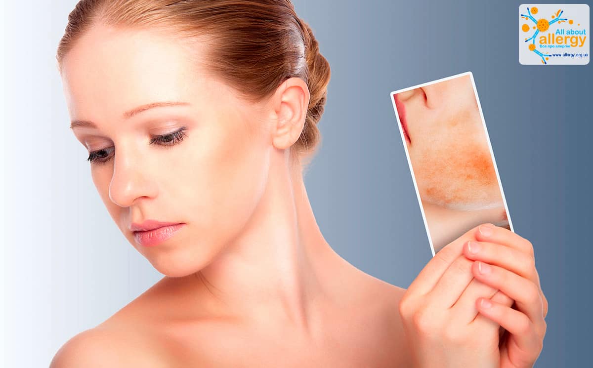 HOW TO TREAT ALLERGIES