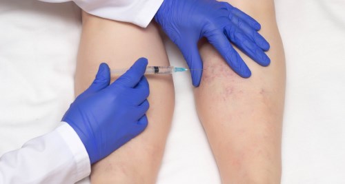 Which Ointments and Medications Help with Varicose Veins?
